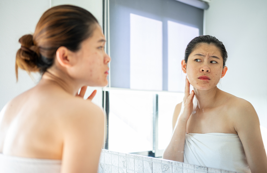 Acne - chemical peel in Essex