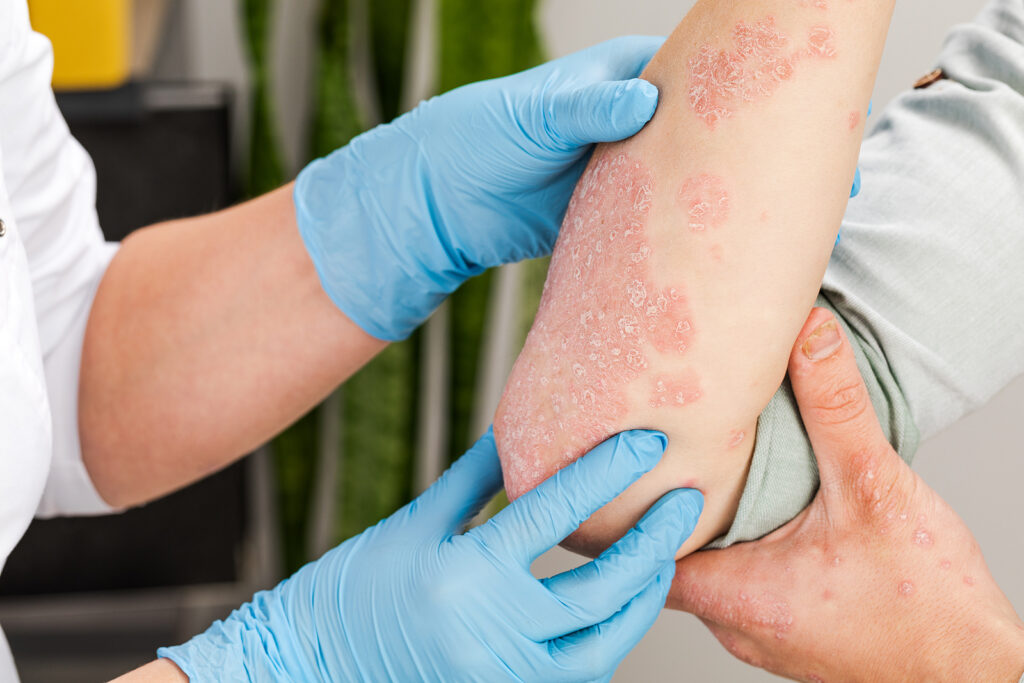A dermatologist wearing gloves examines the skin of a sick patient. Examination and diagnosis of skin diseases-allergies, psoriasis, eczema, dermatitis.