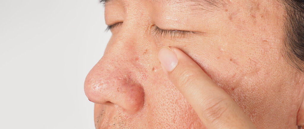 Wart Skin Removal. Macro Shot Of Warts Near Eye On Face.