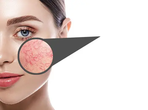 laser skin clinic - Rosacea