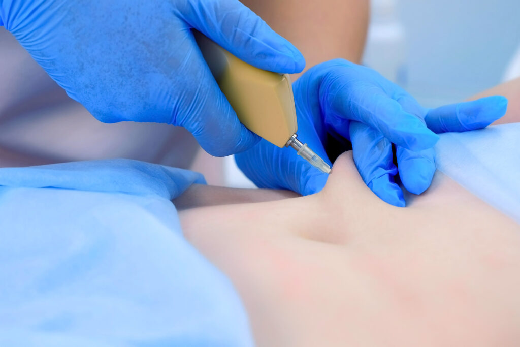 cryopen UK - making injection carbon dioxide in patient abdomen