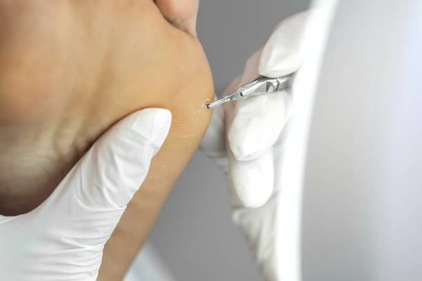 cryopen treatment - Wart removal