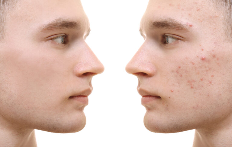 acne treatments dagenham - Young man before and after acne treatment