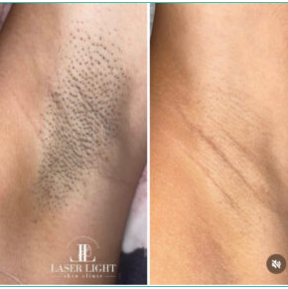 Laser hair removal by skin and laser specialists Dagenham