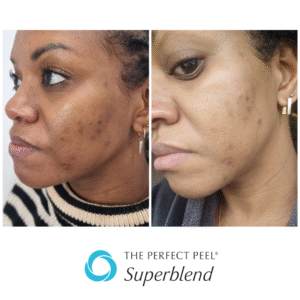 Here’s how Laser Light Skin Clinic Dagenham helped a customer with her skin condition. 